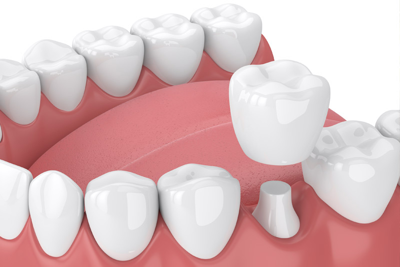 Dental Crowns in Pflugerville