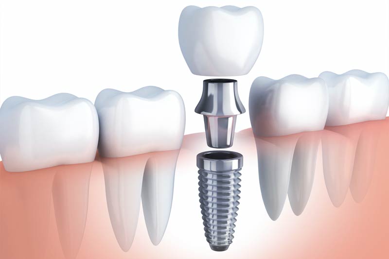 Implants Dentist in Pflugerville