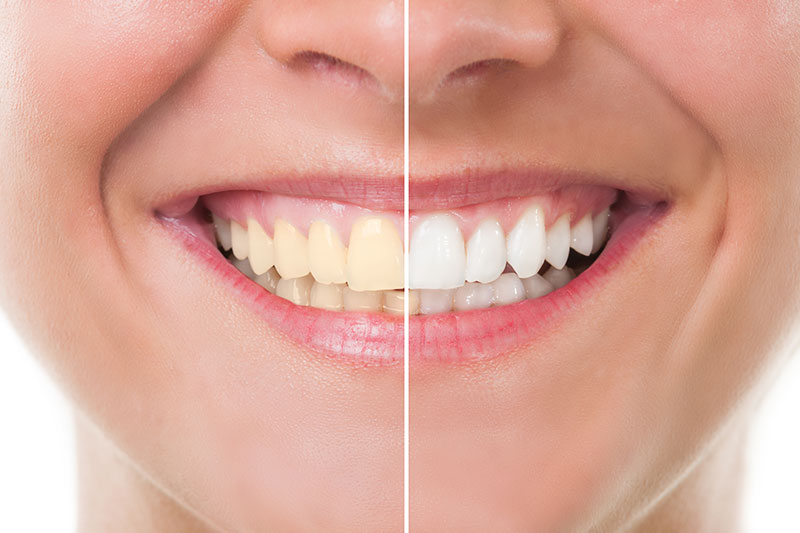 Teeth Whitening in Pflugerville