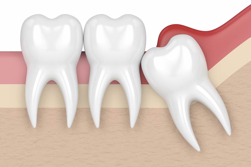 Wisdom Tooth Removal in Pflugerville